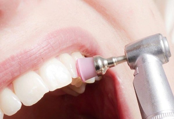 dental-polishing